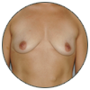 Prothèses mammaires - Patientes aux seins relâchés