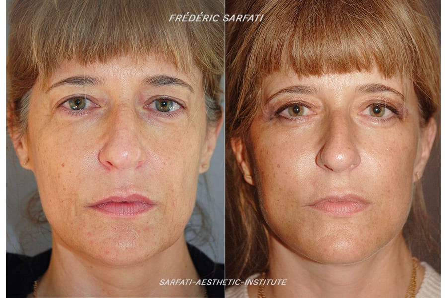 20 lifting cervico facial blepharoplastie avant apres resultat face 7 chirurgie esthetique du visage docteur frederic sauveur sarfati chirurgien esthetique paris