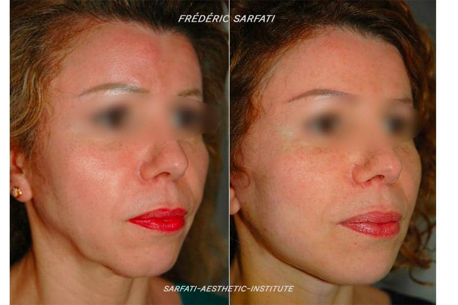 20 lifting cervico facial avant apres resultat biais 5 chirurgie esthetique du visage dr frederic sauveur sarfati chirurgien esthetique paris