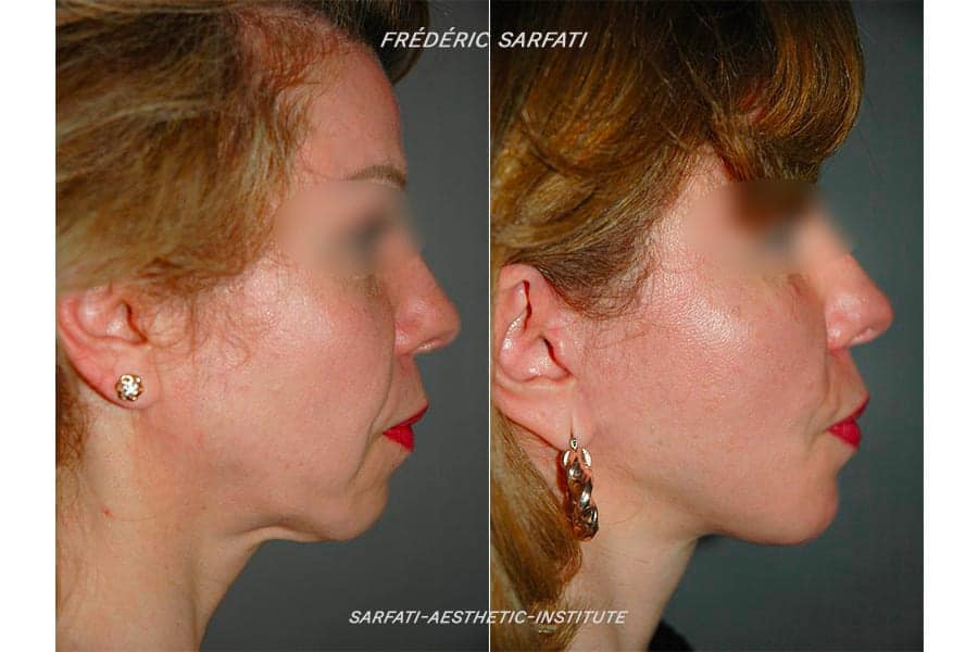 20 lifting cervico facial avant apres resultat cote 5 chirurgie esthetique du visage dr frederic sauveur sarfati chirurgien esthetique paris