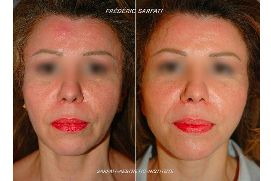 20 lifting cervico facial avant apres resultat face 5 chirurgie esthetique du visage dr frederic sauveur sarfati chirurgien esthetique paris