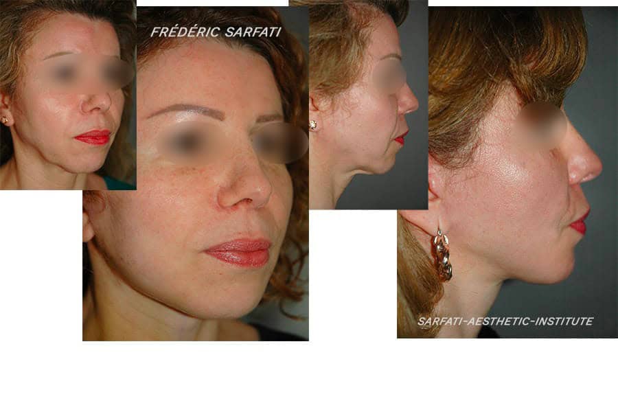 21 lifting cervico facial avant apres resultat cote biais chirurgie esthetique du visage dr frederic sauveur sarfati chirurgien esthetique paris
