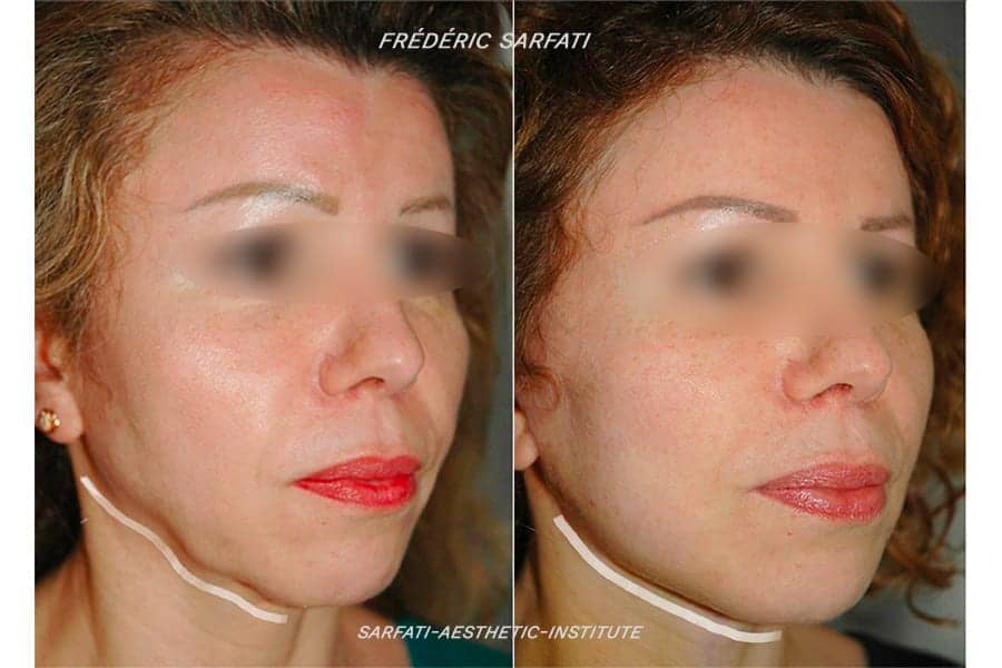 27 lifting cervico facial lipoaspiration bajoues avant apres resultat biais chirurgie esthetique du visage dr frederic sauveur sarfati chirurgien esthetique paris